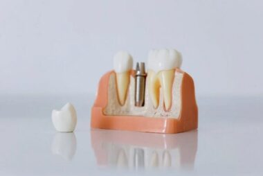 implants